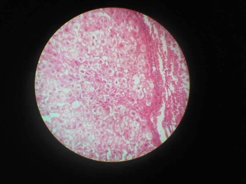 肝细胞颗粒变性图片