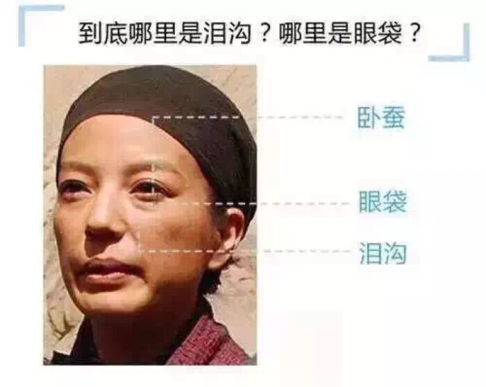 【眼袋和上眼皮肿】有亲眼下总是有厚厚的眼袋,这其实是一种水肿.