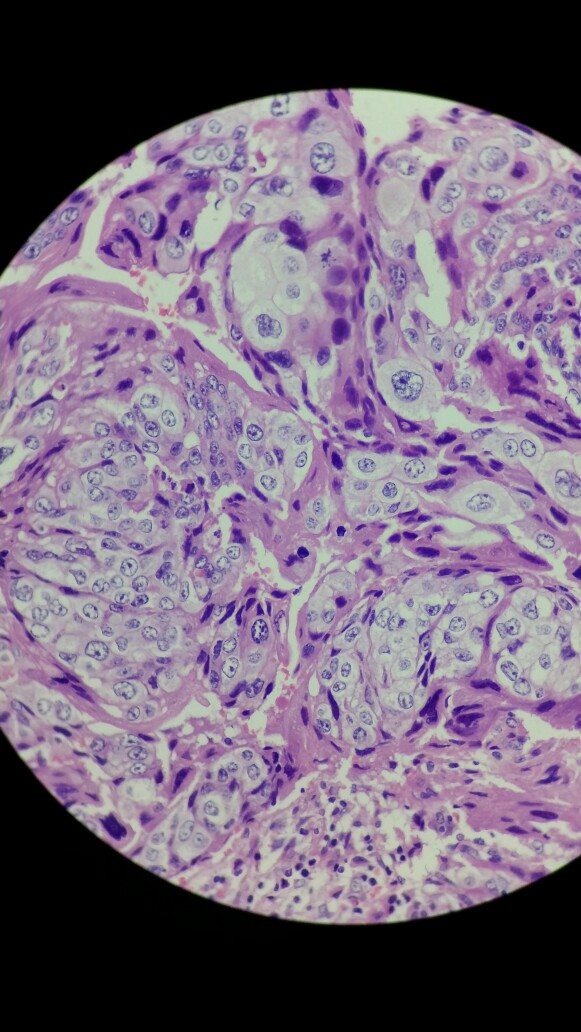 绒毛膜癌病理图片图片