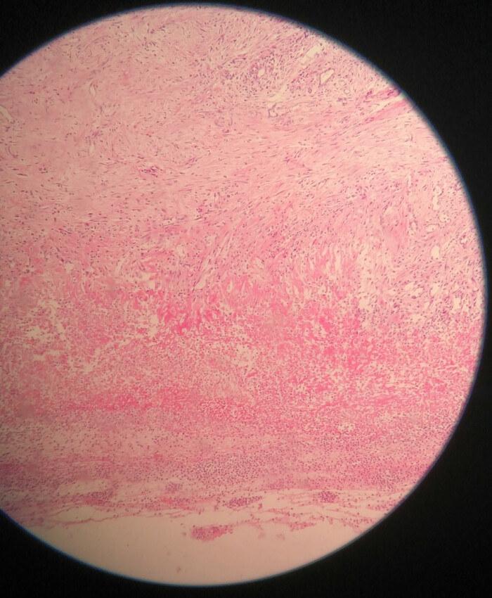 胃溃疡显微镜下图片图片