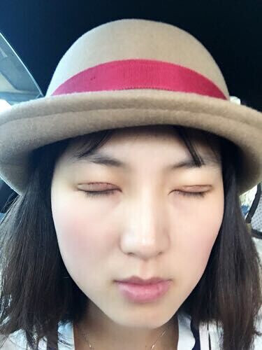 全切双眼皮术后一周