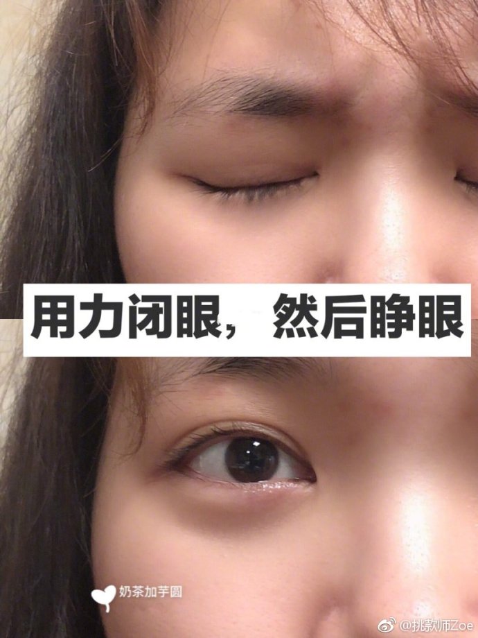 400度视力恢复眼睛有神不外凸