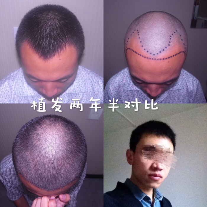 发际线调整,两年半效果对比北京植发|植发效果对比|植发李主任
