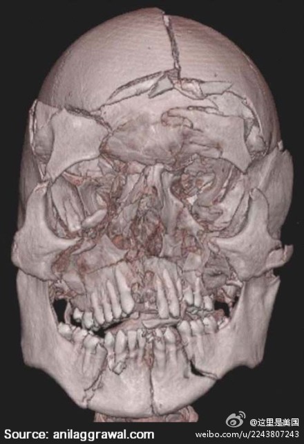 从40米高桥跳下的自杀者,面部着地,死后3d-ct显示面部骨广泛骨折