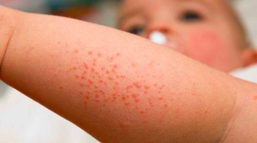 麻疹(measles),又称小儿麻疹.