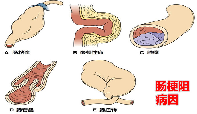 为什么会得肠梗阻 堆糖网